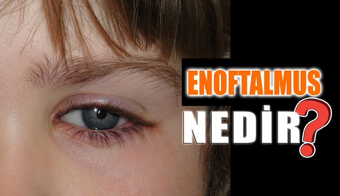 Enoftalmus Nedir?