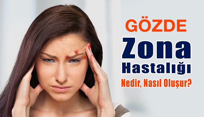 Gözde Zona Hastalığı: Nedir, Nasıl Oluşur?