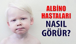 Beyaz Melek Albino Hastaları Ve Görme Kusurları