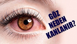 Göz Kanlanmasını Hafife Almayın!