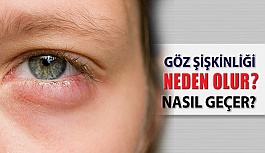 Göz şişkinliği neden olur?  Nasıl Geçer?