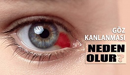 Göz Kanlanması Neden Olur? Nasıl Geçer?