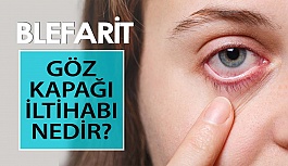 Göz Kapağı İltihabı Blefarit Nedir? Nasıl Tedavi Edilir?