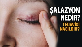 Göz kapağı kisti Şalazyon nedir?