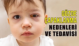 Göz Çapaklanması: Nedenleri ve tedavisi