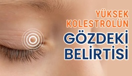 Yüksek Kolestrol Gözden Anlaşılıyor