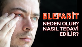 Blefarit Neden Olur Nasıl Tedavi Edilir?