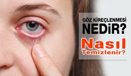 Göz Kireçlenmesi Nedir? Nasıl Tedavi Edilir?