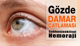 Gözde Kanlanma, Gözde Damar Çatlaması Neden Olur?