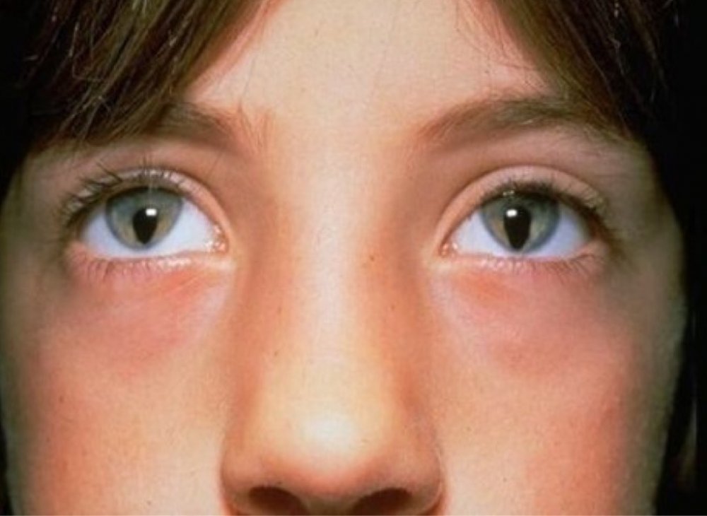 Глаза стали разного. Врожденная колобома Радужки. Миоз мидриаз анизокория.