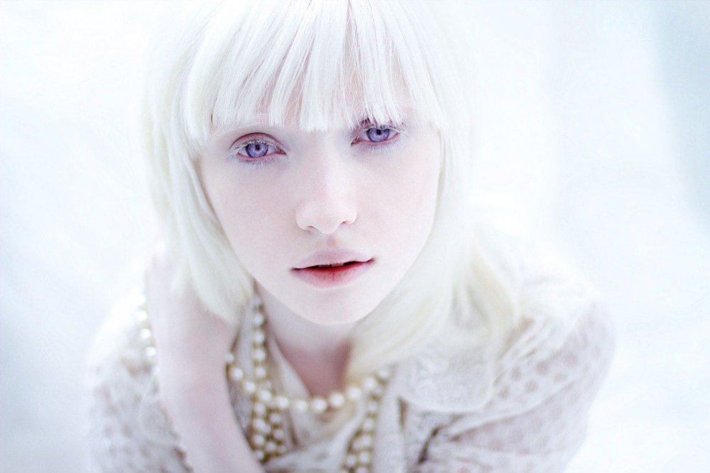 Beyaz Melek Albino Hastalari Ve Gorme Kusurlari Optik Gazete